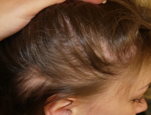 Androgenic Alopecia In Women How To Treat Androgenetic Alopecia